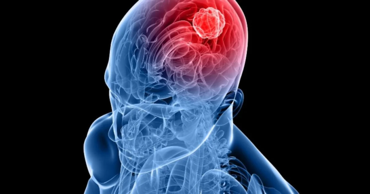 As intervenções mais eficazes combinam terapias como a Terapia Cognitivo-Comportamental (TCC) e o uso de medicamentos específicos.